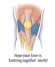 Healing Knee Surgery