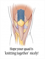 Healing Quadriceps Tendon