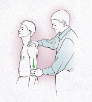 Sulcus Sign