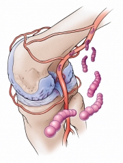 Infectious Arthritis