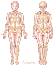 Trigger Points of  Fibromyalgia