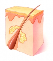 Normal Hair Follicle