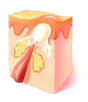 Papule of Acne Vulgaris