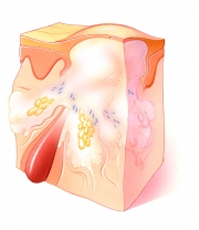 Pustule of Acne Vulgaris