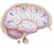 Blood Clot Causes Brain Swelling