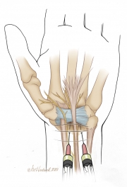 Injections for Carpal Tunnel Syndrome