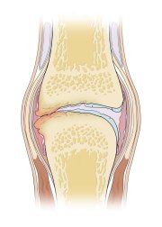 Anatomy of a Joint With Osteoarthitis