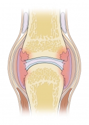 Anatomy of a Joint With Rheumatoid Arthitis