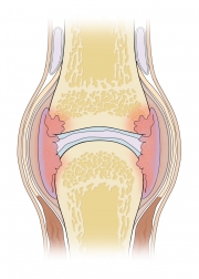 Anatomy of a Joint With Rheumatoid Arthitis