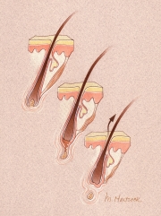 Mechanism of Hair Loss