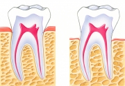 Osteoporosis of the Alveolar Bone