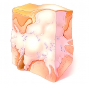Nodulocystic Lesion of Acne Vulgaris