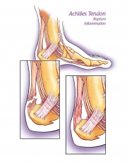 Achilles Tendon Pathology